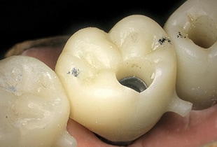 Observación de implantes dentales